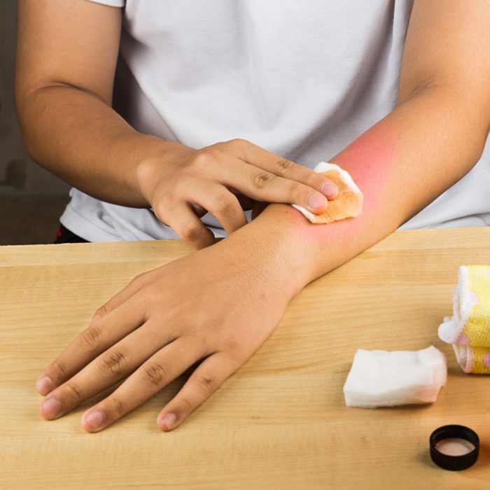 Apple cider vinegar effective natural remedy for skin itch, fungal infection, warts, bruises and burns