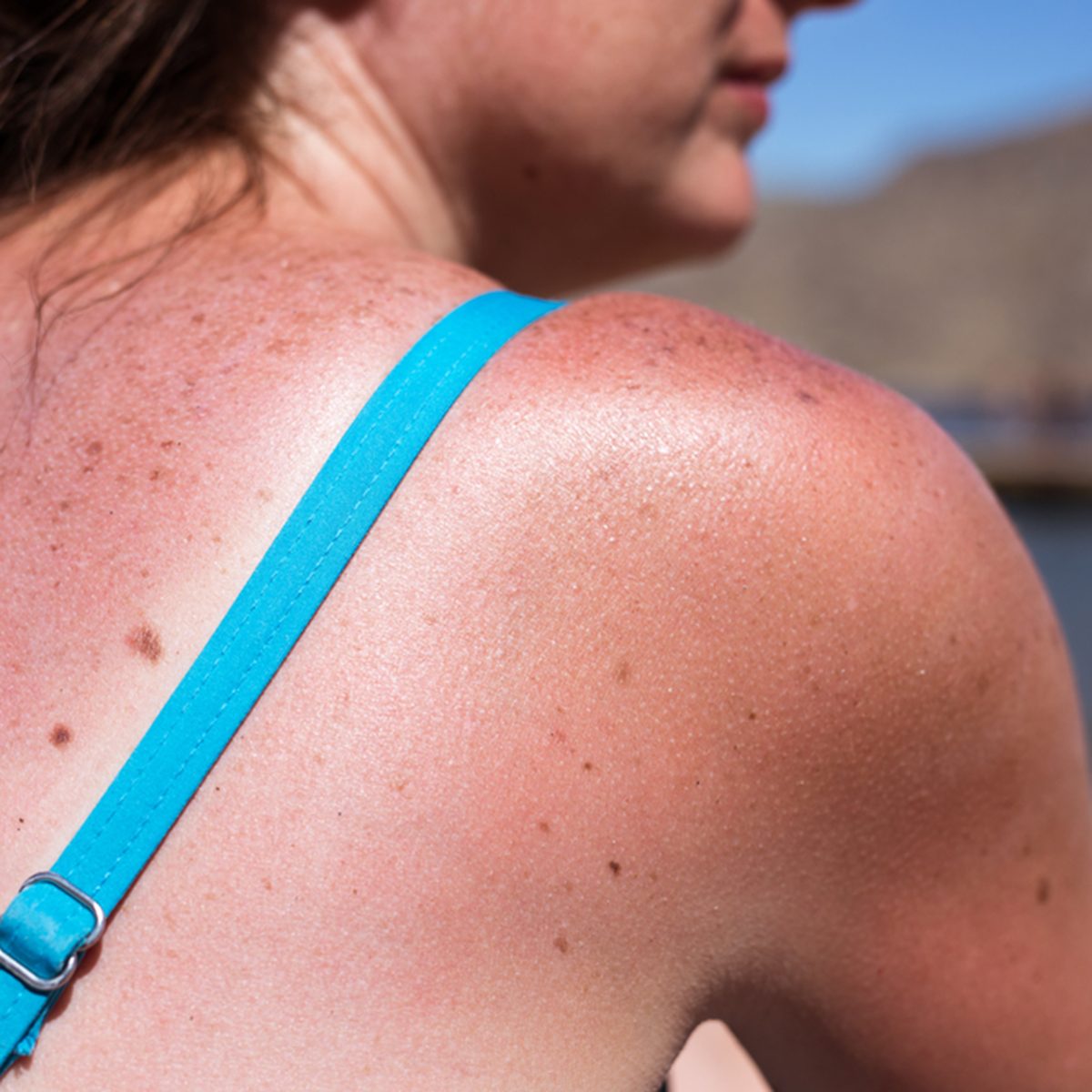 Sunburn from beach sun light on the shoulder and back of caucasian girl